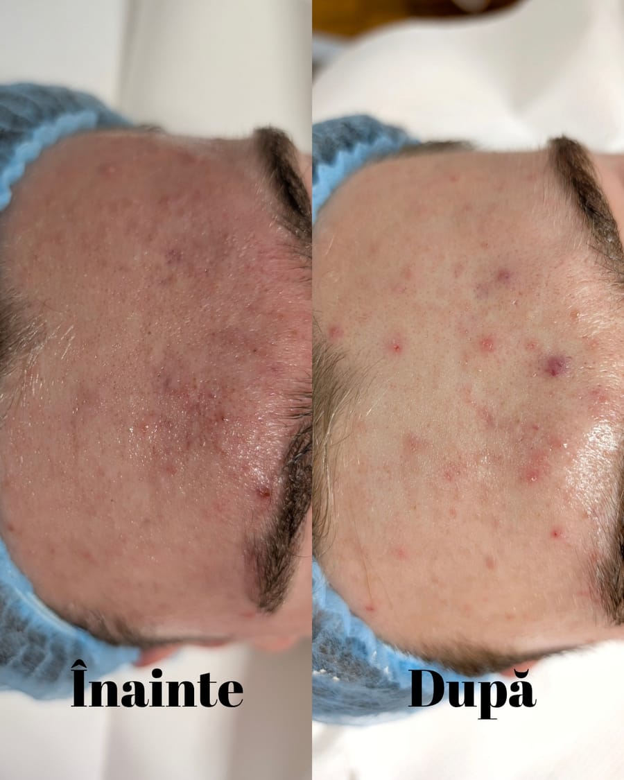 Rezultat înainte și după tratamentul antiacneic — frunte cu inflamație și roșeață vizibil calmate